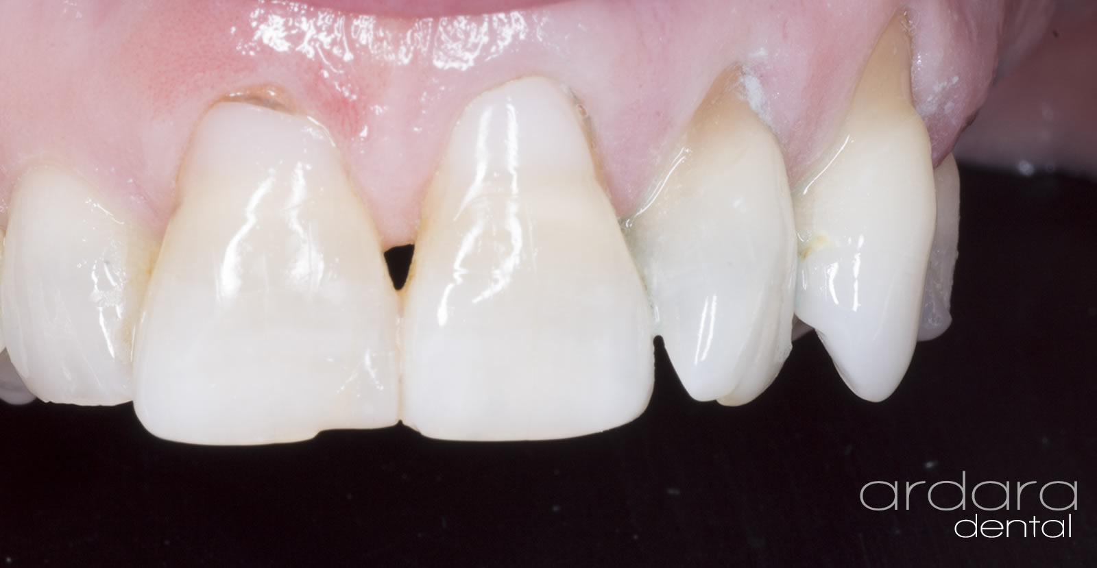 tooth whitening in donegal