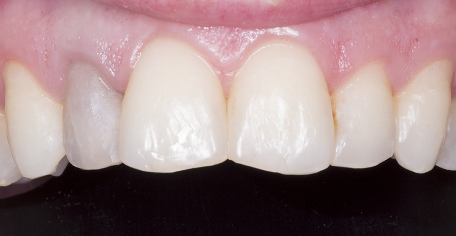 tooth whitening in donegal